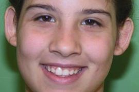 Abstehende Ohren vor OP - Bild 2